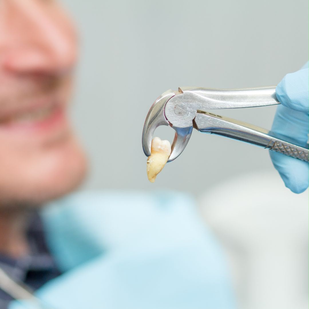 Tooth extraction treatment